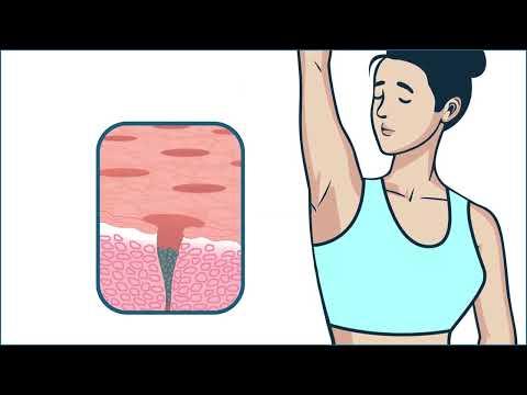How Antiperspirants Work